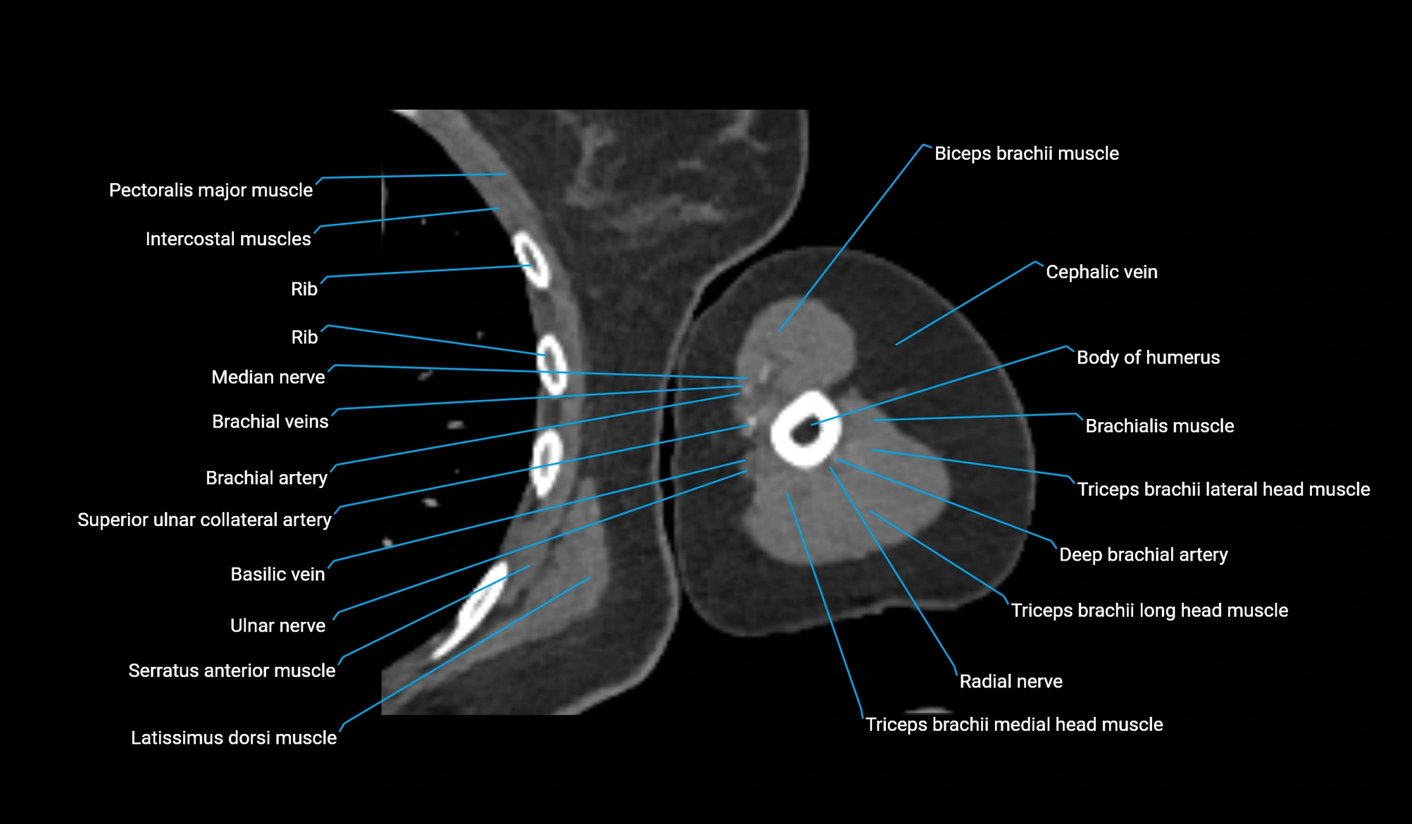 CT upper arm axial  cross sectional anatomy labelled radiology image -00236.webp